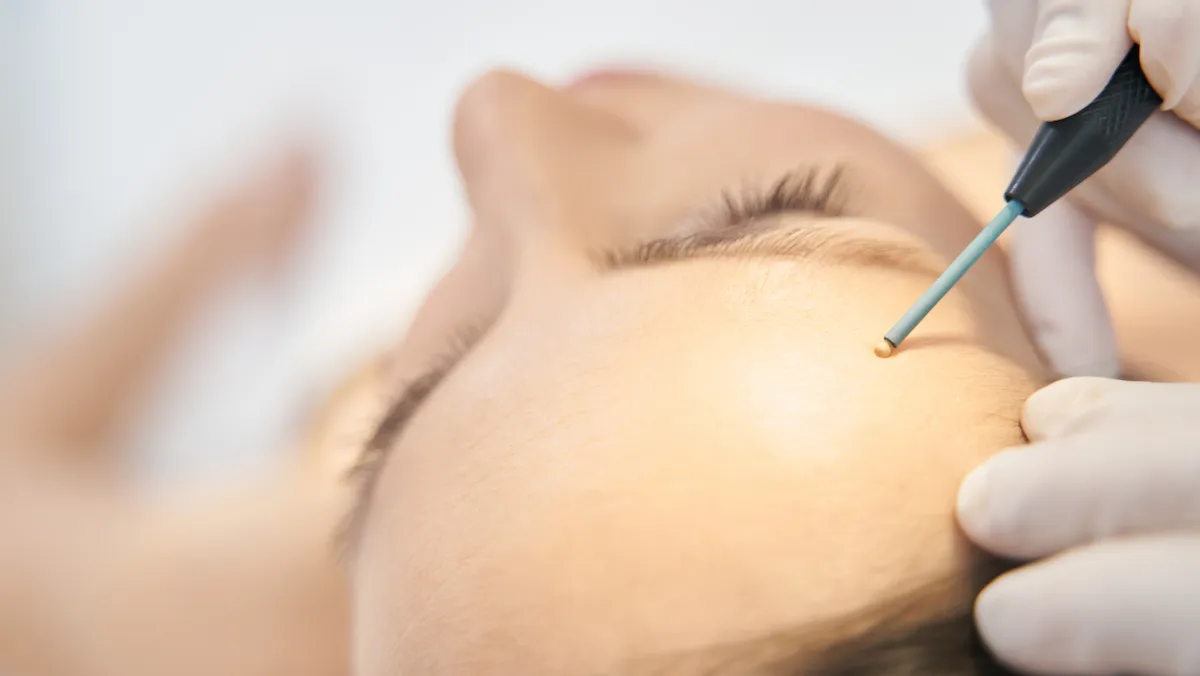 Wart Removal in Chennai