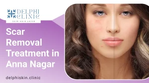 Scar Removal Treatment in Anna Nagar