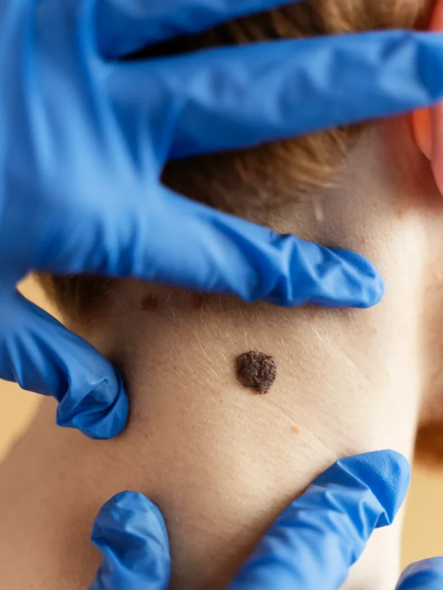 Warts Removal Treatment in Anna Nagar